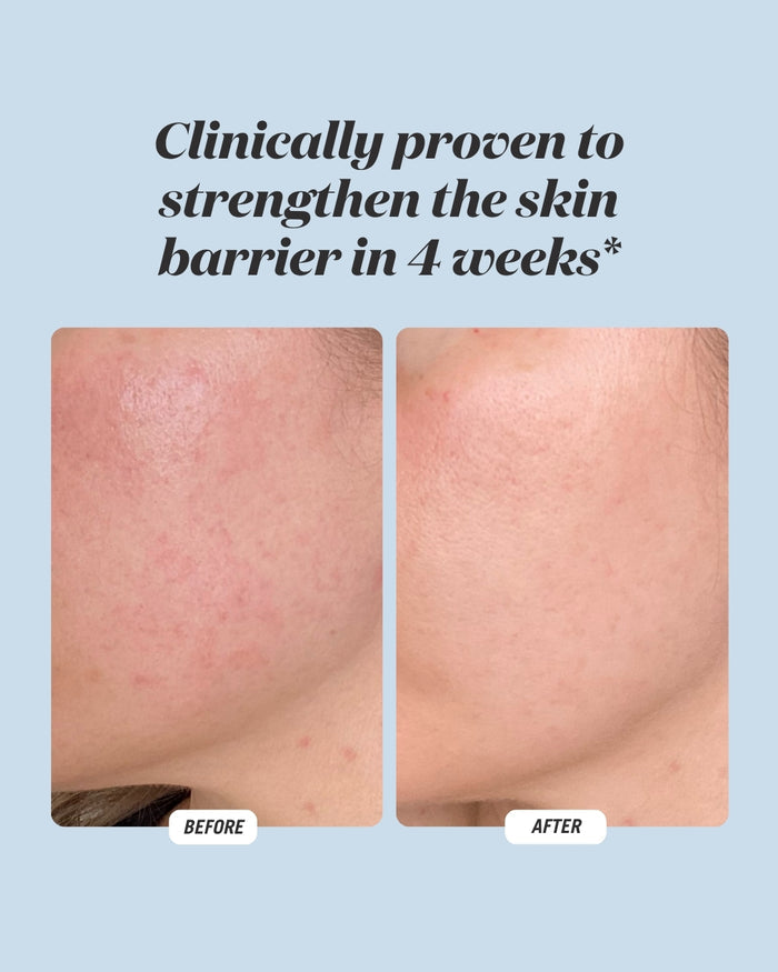 Before and after results for Common Clouds Cloud Drops hydrating serum, showing visibly calmer skin and a strengthened skin barrier after 4 weeks.
