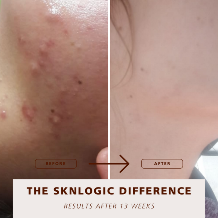 SKNKIT009 SKNLOGIC Clearer Skin Retail Kit | Before and after comparison of skin treatment results labeled 'The Sknlogic Difference' after 13 weeks.