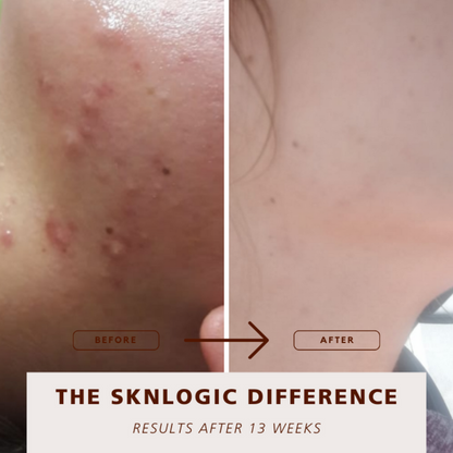 SKNKIT009 SKNLOGIC Clearer Skin Retail Kit | Before and after comparison of skin treatment results labeled 'The Sknlogic Difference' after 13 weeks.