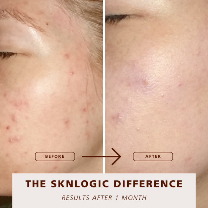 SKNKIT009 SKNLOGIC Clearer Skin Retail Kit | Before and after comparison of skin treatment results labeled 'The Sknlogic Difference' with text indicating a one-month duration.