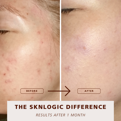 SKNKIT009 SKNLOGIC Clearer Skin Retail Kit | Before and after comparison of skin treatment results labeled 'The Sknlogic Difference' with text indicating a one-month duration.