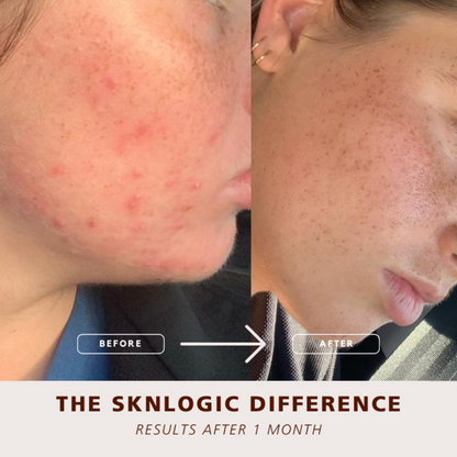 SKNKIT009 SKNLOGIC Clearer Skin Retail Kit | Before and after comparison of skin treatment results with 'The Sknlogic Difference' text.